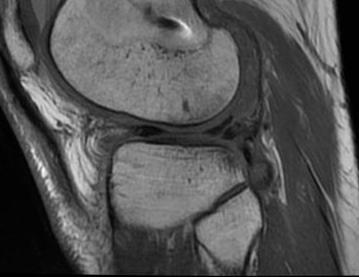 Mensicus Failed Repair MRI0001